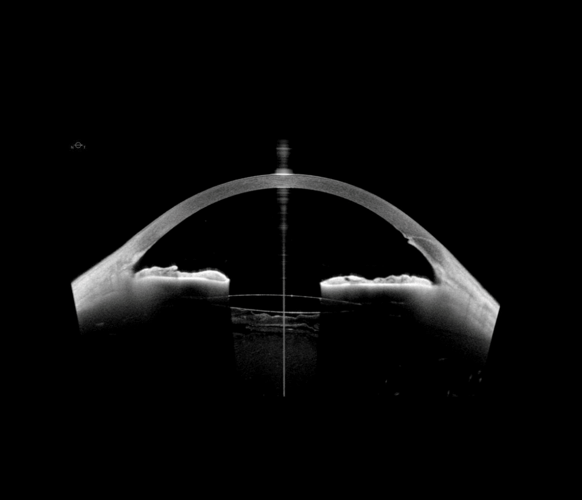 Cristallino artificiale dopo estrazione di cataratta.png