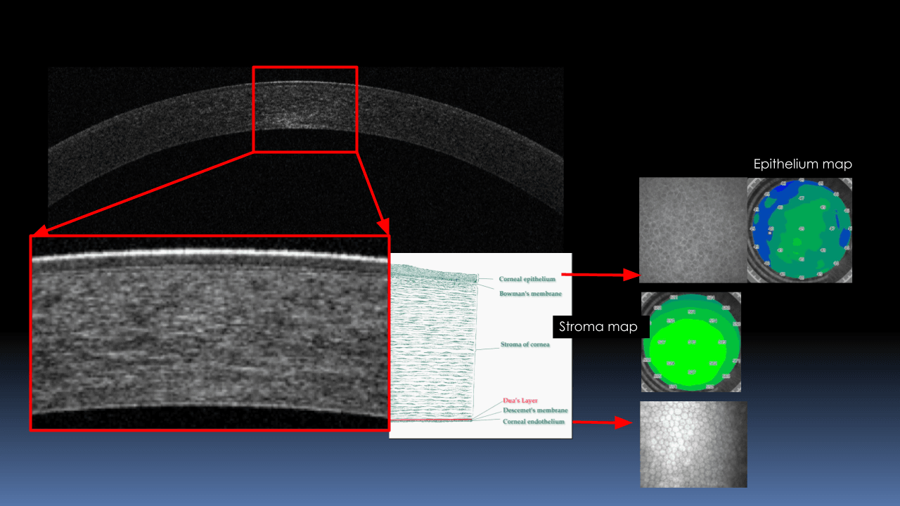 OCT anteriore.pptx.png