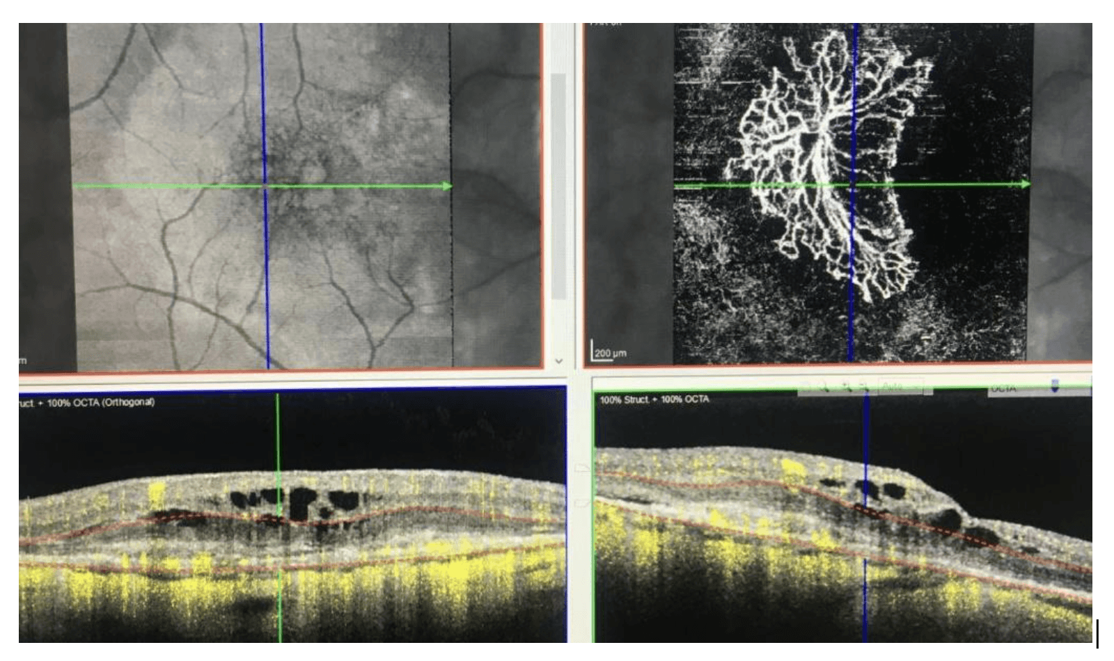 Angio OCT in maculopatia con evidente membrana neovscaolare