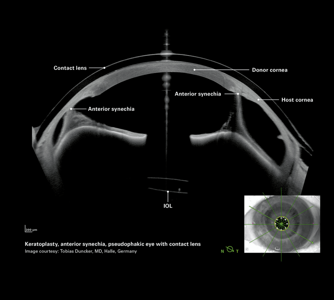 Trapianto con aderenze iride -cornea.png