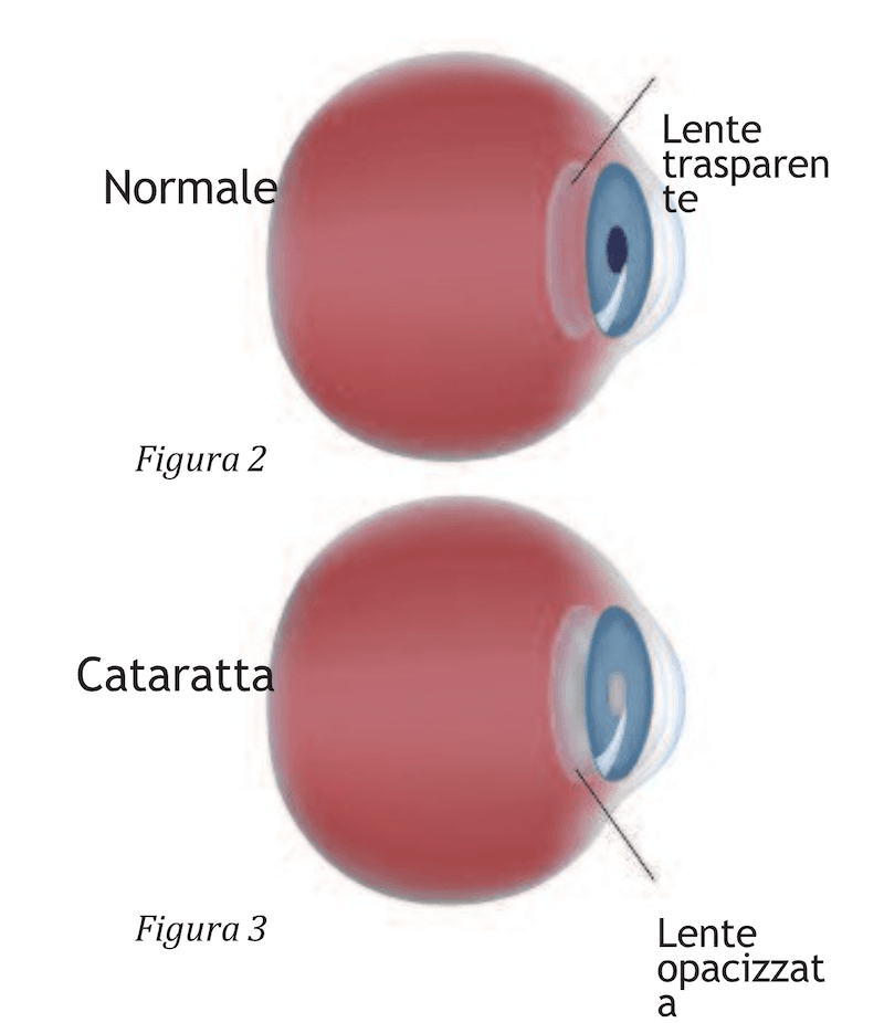 cataratta-fig-2-3.png