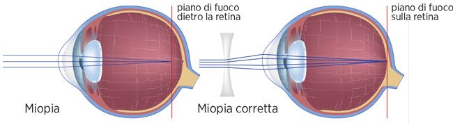 miopia
